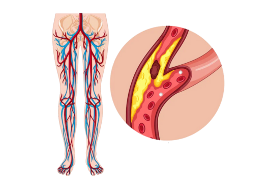 Peripheral Arterial Disease